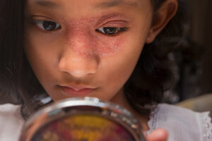 Child with eczema who can participate in a clinical trial